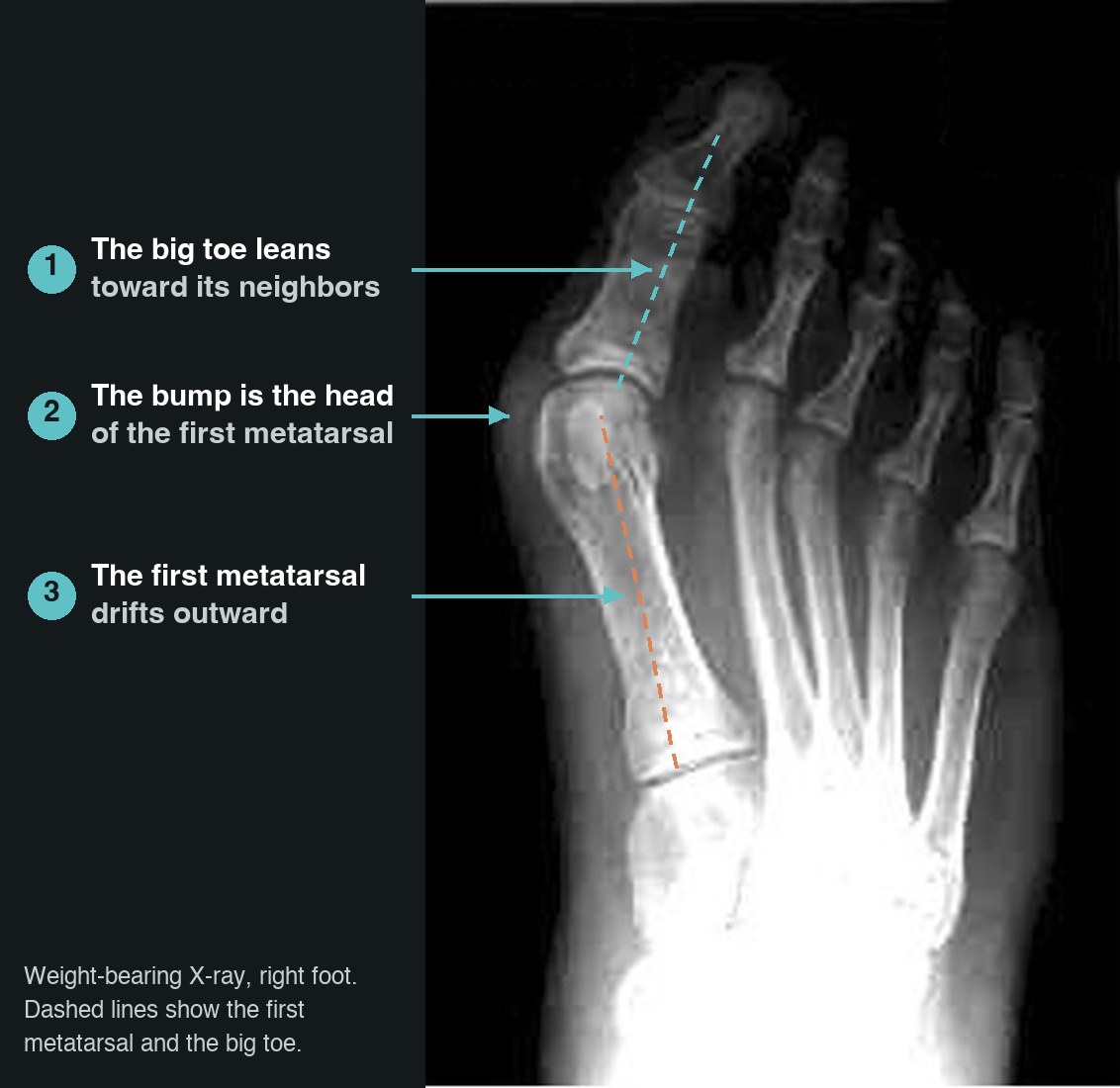 Weight-bearing X-ray of a bunion, with arrows showing the big toe leaning toward the other toes and the first metatarsal drifting outward